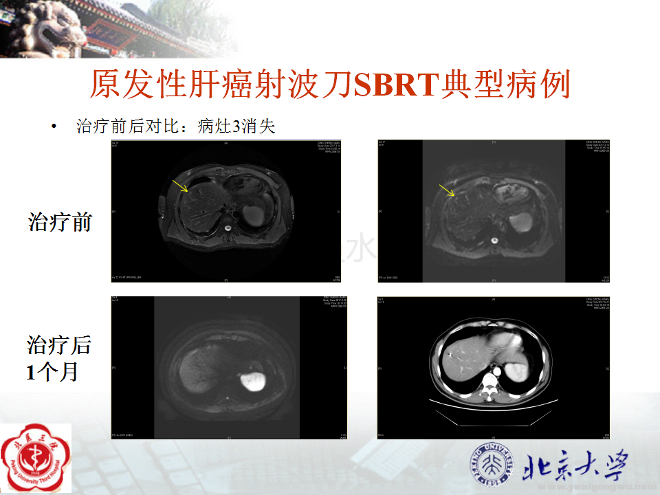 原发性肝癌典型病例3个病灶_05.png